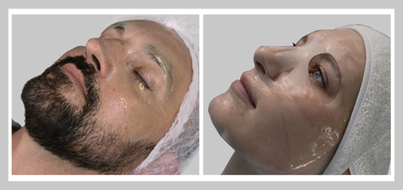 Рис. 6. Нанесение маски: пациент В., 50 лет, в маске (А); пациентка О., 29 лет, в маске (Б)